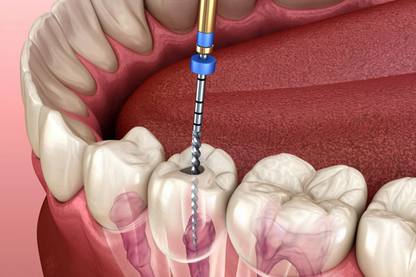 root-canal-treatment